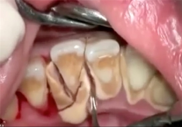 (تصویر) اثرات 10 سال مسواک نکردن دندان‌ها