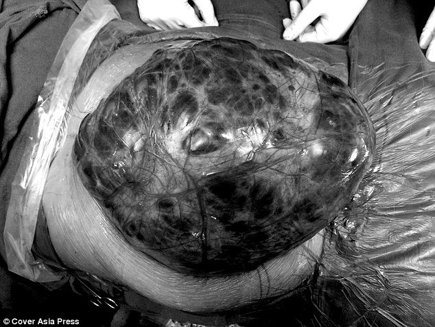 (تصاویر) غده 7 کیلویی در شکم یک زن