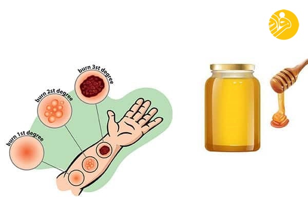 درمان‌های خانگی با استفاده از عسل طبیعی