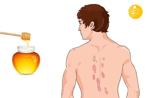 درمان‌های خانگی با استفاده از عسل طبیعی