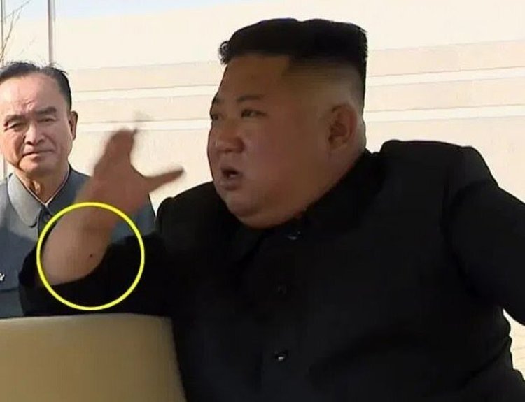 جای سوزن بر مچ کیم جونگ اون؛ رهبر کره شمالی عمل جراحی انجام داده است؟