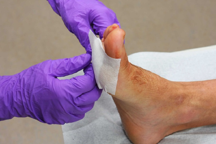 زخم پای دیابیتی؛ علل، نشانه‌ها و راه‌های درمان آن