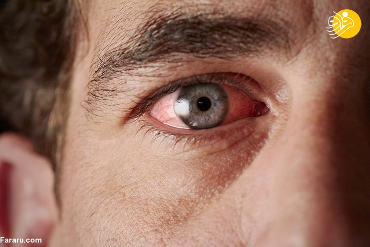 همه چیز درباره آلرژی چشم؛ علائم و درمان