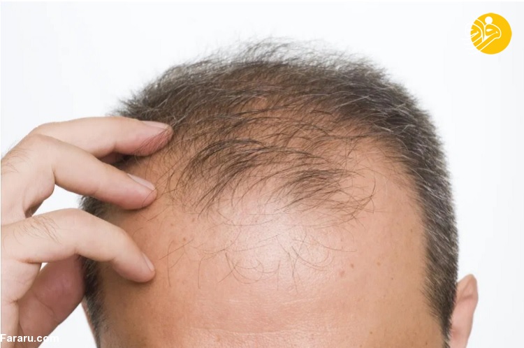 دلایل رایج ریزش مو در تابستان و پاییز چیست؟
