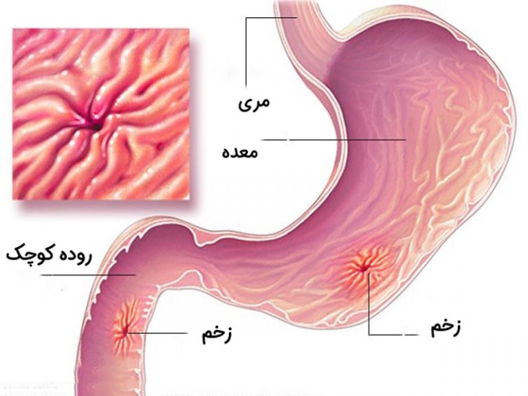 زخم معده