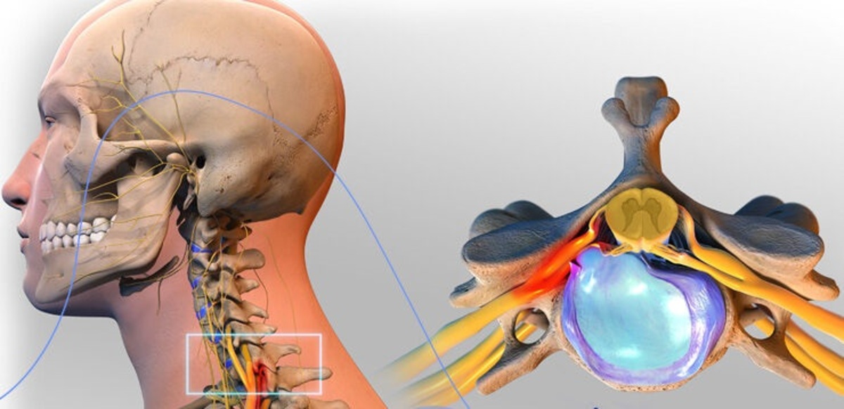 دیسک گردن چیست؟ علائم و روش‌های درمان کاربردی